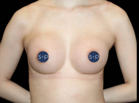 Preservé breast augmentation after — Case 1