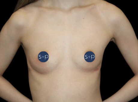Preservé breast augmentation before — Case 1