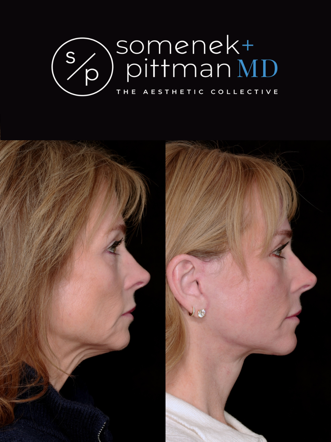 Deep plane facelift before and after — Profile view